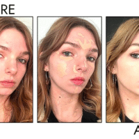 Консилер для лікування акне